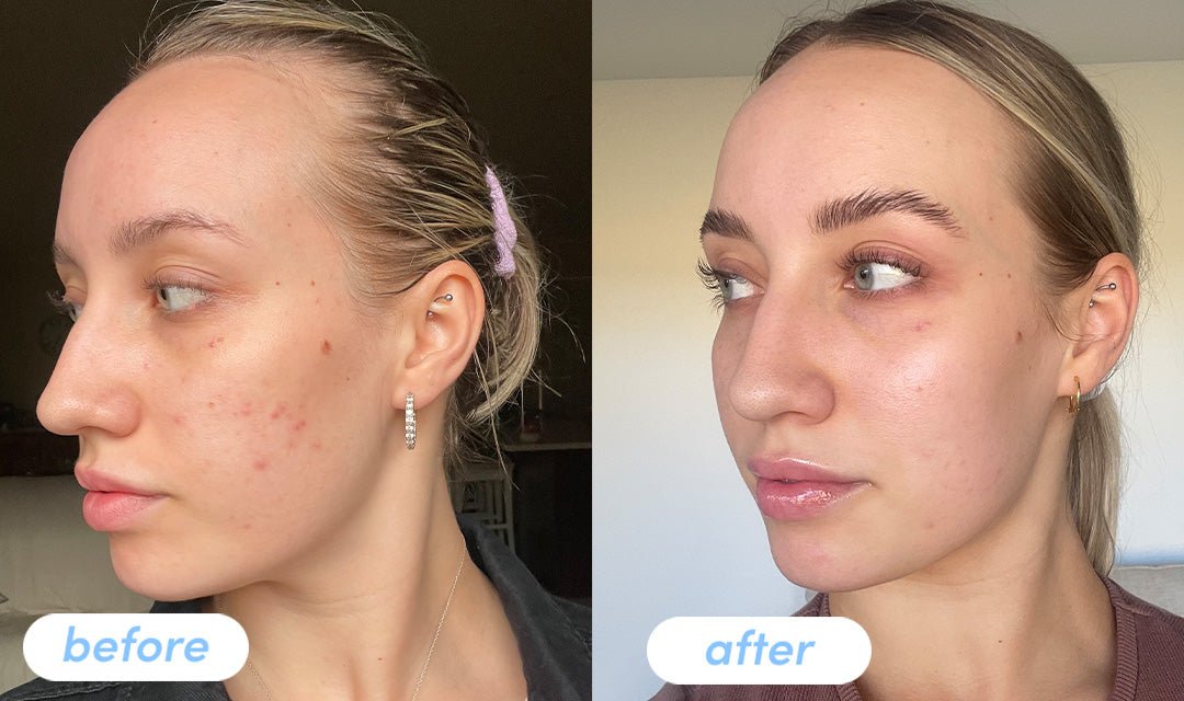 klow peptide review before and after Glow Dark Circles GLOW Peptide Journey: 3-Week Progress